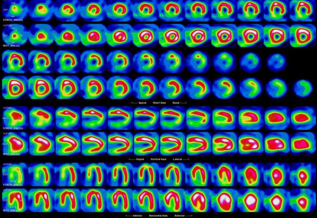 La Scintigraphie Myocardique Au Thallium MIBI Docteur Imago