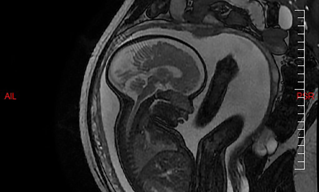 L’IRM fœtale détecterait mieux les malformations cérébrales que l’échographie Docteur Imago