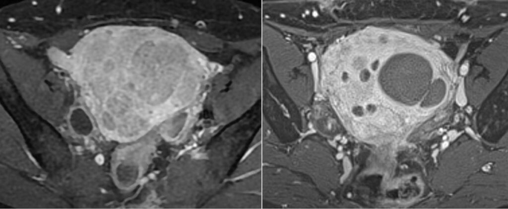 Lembolisation De Fibrome Utérin Docteur Imago