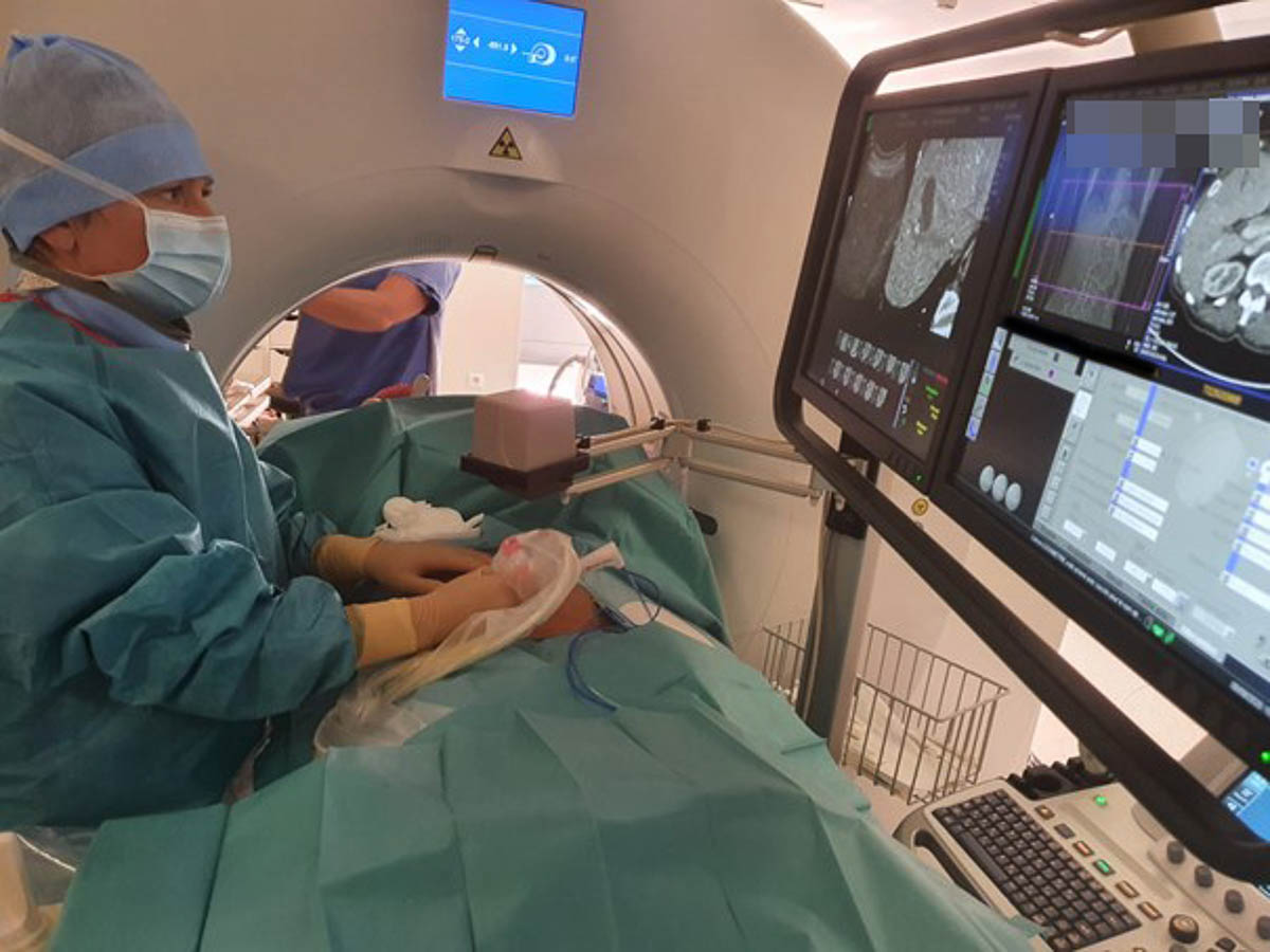 Le traitement des lésions hépatiques par radiofréquence Docteur Imago