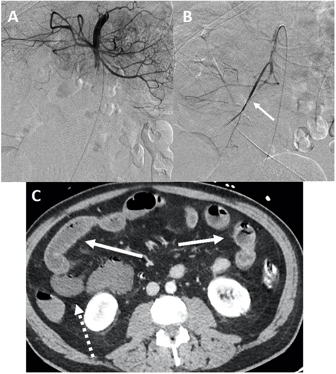 Indications et techniques de revascularisation endovasculaire des ...