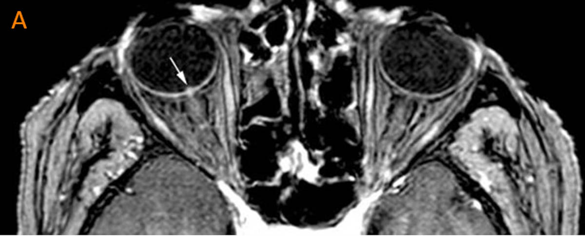 L imagerie IRM des neuropathies optiques isch miques ant rieures