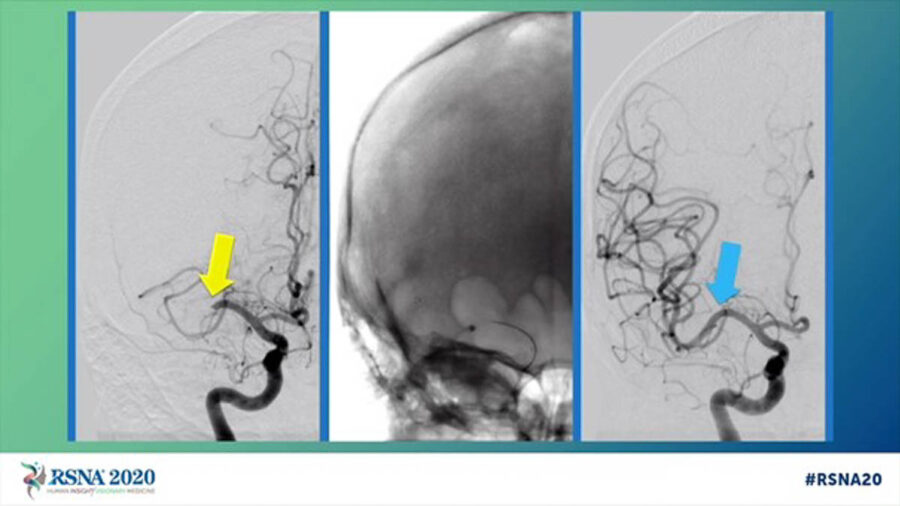 Ces Essais Qui élargissent Les Indications De La Thrombectomie ...