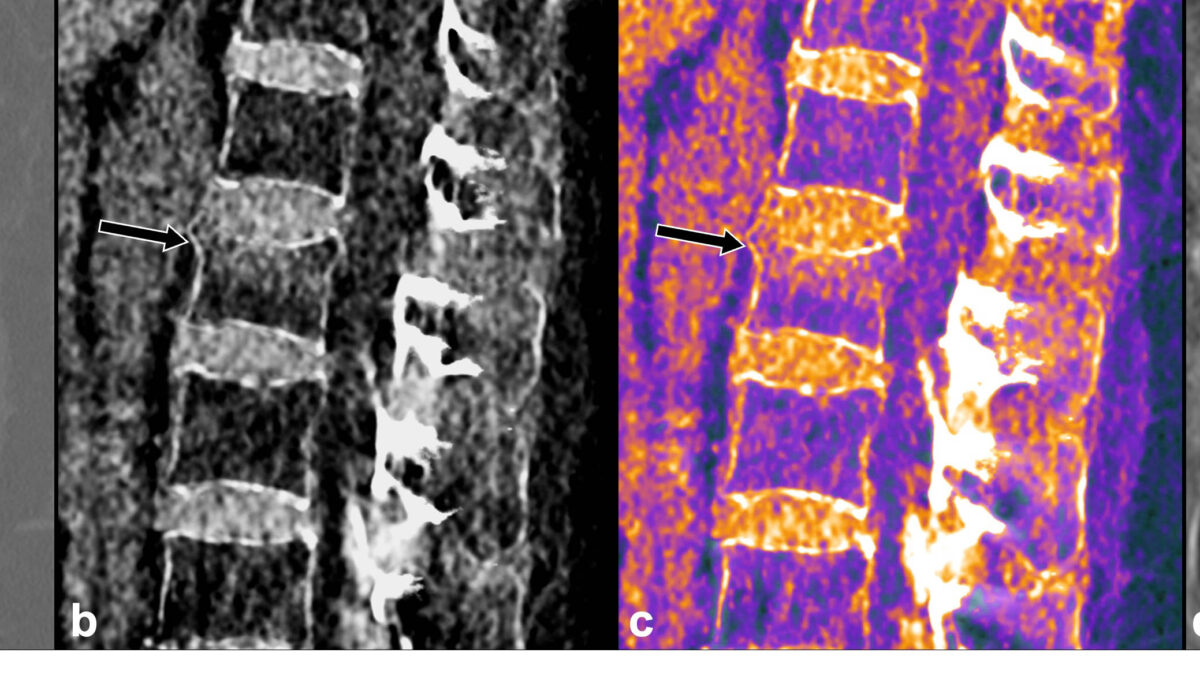 Le scanner spectral pour la détection des fractures occultes - Docteur ...