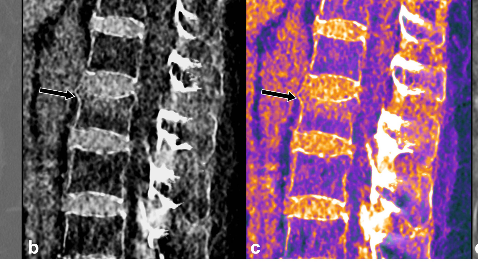 Figure 4. Fracture-tassement du corps vertébral de L2 chez une patiente de 67 ans. Un œdème osseux traduisant le caractère récent de la fracture est visible sous le plateau supérieur sur les séries VNCa (b) et fusionnée (c) avec la correspondance sur la séquence STIR en IRM (d).