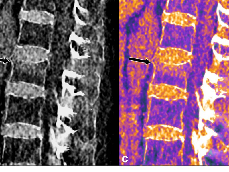 Figure 4. Fracture-tassement du corps vertébral de L2 chez une patiente de 67 ans. Un œdème osseux traduisant le caractère récent de la fracture est visible sous le plateau supérieur sur les séries VNCa (b) et fusionnée (c) avec la correspondance sur la séquence STIR en IRM (d).