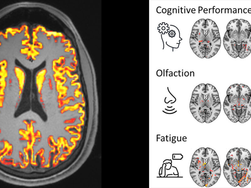 gauche : IRM axiale pondérée en T1 avec une carte des paramètres microstructurels superposée à la matière grise. / droite : Régions du cerveau dans lesquelles la microstructure a été associée aux symptômes associés à la condition post-COVID. © RSNA