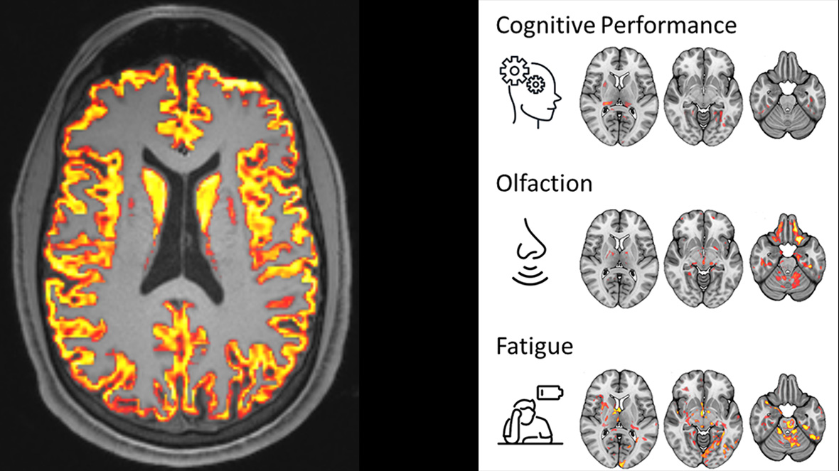 gauche : IRM axiale pondérée en T1 avec une carte des paramètres microstructurels superposée à la matière grise. / droite : Régions du cerveau dans lesquelles la microstructure a été associée aux symptômes associés à la condition post-COVID. © RSNA