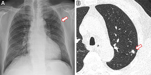 Frontal chest X-ray shows a small nodular opacity (arrow) in the left upper lung zone. Axial, non-contrast, low-dose chest CT scan shows a 9-mm solid nodule (arrow) in the left upper lobe. © RSNA 2023