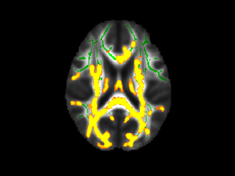 Cette figure montre une neuroinflammation accrue (couleurs jaunes) associée à une plus grande quantité de graisse cachée (graisse viscérale) dans la cohorte de 54 participants âgés en moyenne de 50 ans dans la substance blanche du cerveau. Les couleurs vertes correspondent à la substance blanche normale.