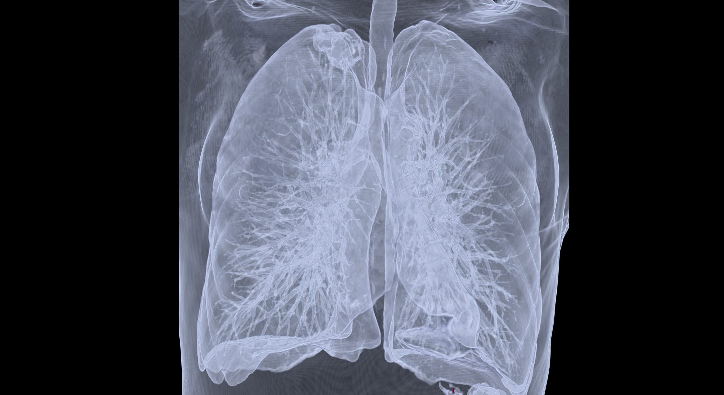 Scanner dépistage cancer du poumon © Marie-Pierre Revel / AP-HP