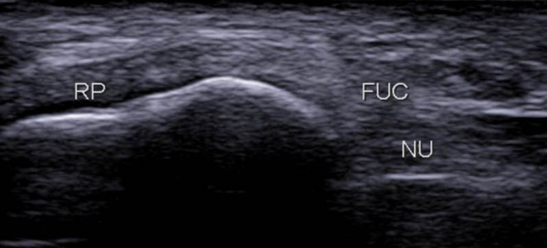 Figure 11. Coupe axiale proximale montrant le RP en antérieur et le FUC (tapissant le nerf ulnaire (NU)) en postérieur.