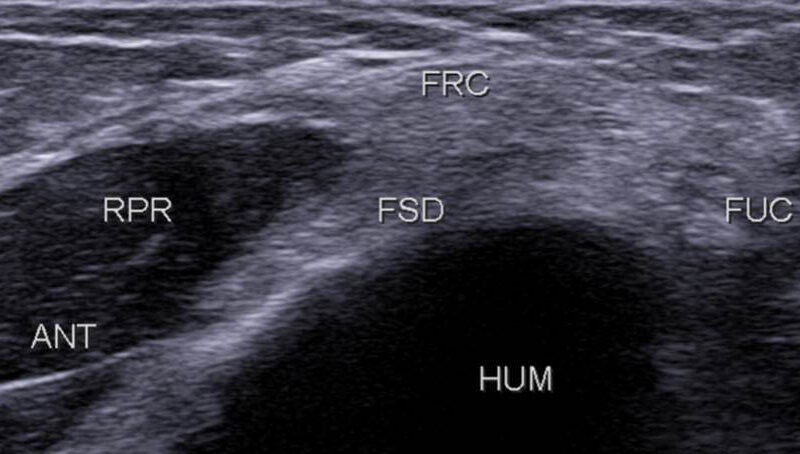 Figure 13. Ensuite, le FSD est visualisé en profondeur du FRC, entre le muscle RP (RPR) en avant et le FUC en postérieur.