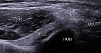 Figure 14. Les tendons du FRC (en superficie) et du FSD (en profondeur) forment un « V » à sommet postérieur renfermant le muscle RP (RPR).