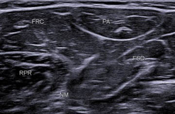 Figure 15. À la partie proximale de l’avant-bras, on visualise les différents muscles et en particulier une structure ovale superficielle, typique, (PA) qui correspond au muscle palmaire, entouré du FRC en avant et du FSD en postérieur.