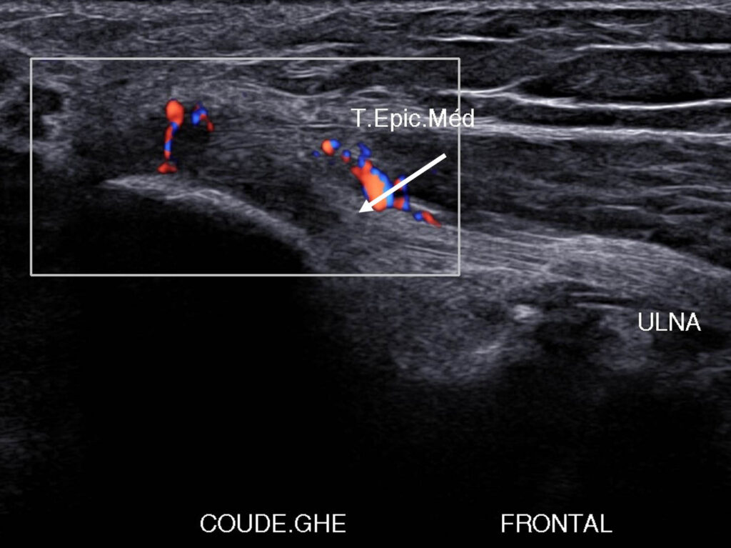 Figure 17. Lésion postérieure et distale atteignant l’insertion proximale du FUC avec atteinte de l’attache humérale du ligament collatéral médial.