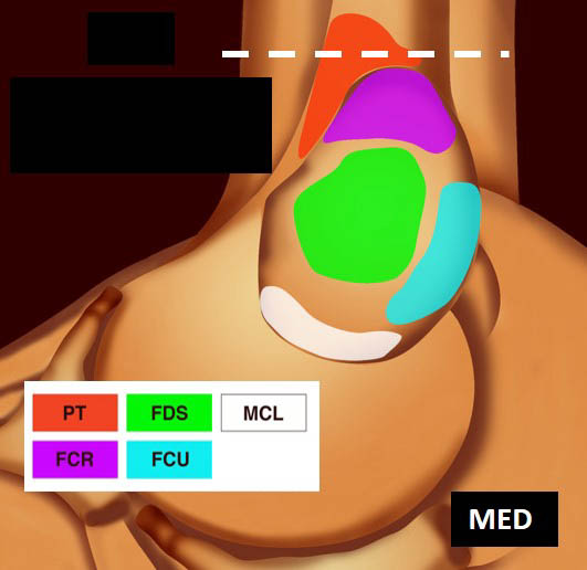 Figure 6. Coupe frontale proximale du rond pronateur (PRT) qui s’insère sur la crète supracondylienne médiale (a) ; schéma correspondant (b).