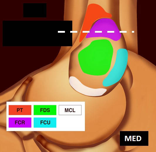 Figure 7. Coupe frontale de l’attache du tendon du FRC tapissé par les fibres musculaires du PT (a) ; schéma correspondant (b).