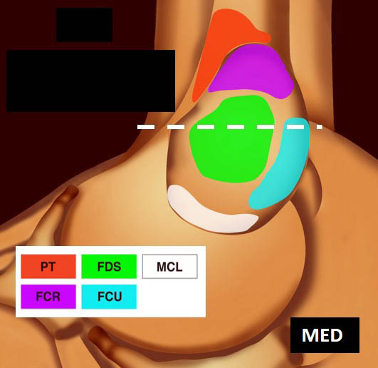 Figure 8. Insertion du FSD sur la face antérieure oblique de la crète épicondylienne médiale ; on remarque que les fibres « plongent » rapidement en profondeur (a) ; schéma correspondant (b).