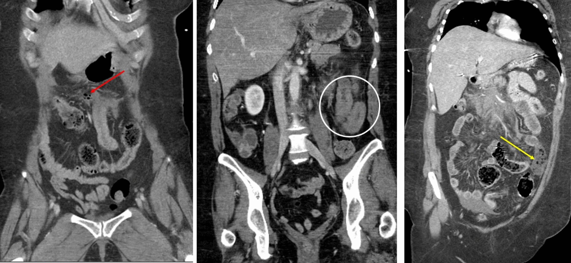 (Left) Coronal CT of the abdomen showing a collection of free air and fluid adjacent to a small bowel loop (red arrow). (Center) Coronal CT of the abdomen in a different patient showing bowel wall thickening with interloop fluid collection (white circle). (Right) Coronal CT of the abdomen in a different patient showing a devascularized bowel (yellow arrow)