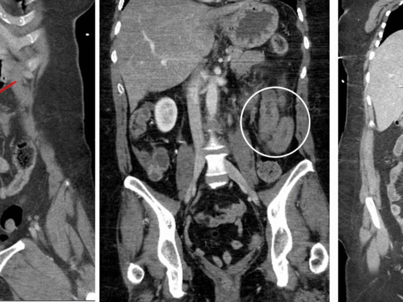 (Left) Coronal CT of the abdomen showing a collection of free air and fluid adjacent to a small bowel loop (red arrow). (Center) Coronal CT of the abdomen in a different patient showing bowel wall thickening with interloop fluid collection (white circle). (Right) Coronal CT of the abdomen in a different patient showing a devascularized bowel (yellow arrow)
