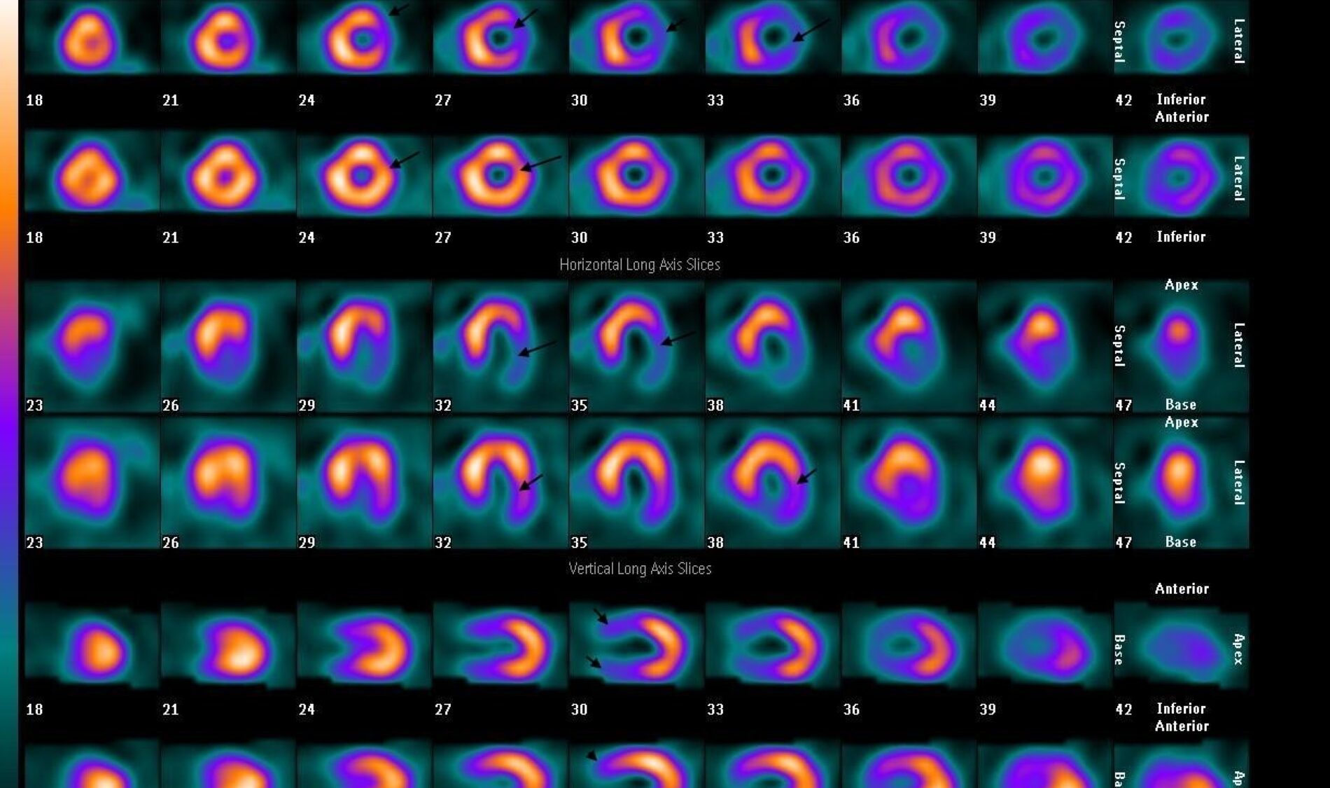 Scintigraphie de perfusion myocardique