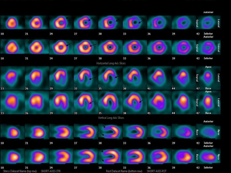 Scintigraphie de perfusion myocardique