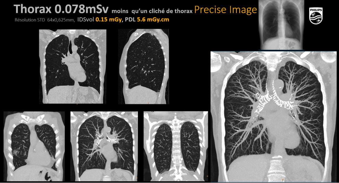 AI and Low-Dose CT in Lung Cancer Screening: The Radiologist’s Role
