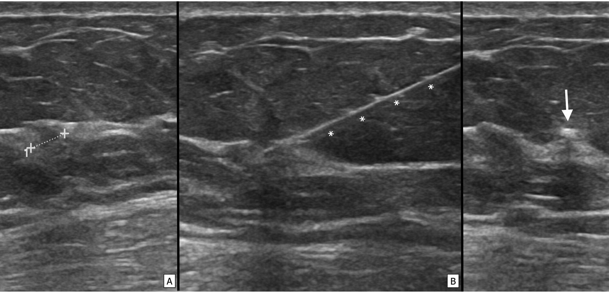 Système Magseed pour le repérage des lésions mammaires. Depretto C., Della Pepa G., De Bernardinis C. et coll., « Magnetic localization of breast lesions: a large scale European evaluation in a national cancer institute », Clinical Breast Cancer, août 2023. DOI : 10.1016/j.clbc.2023.08.004.