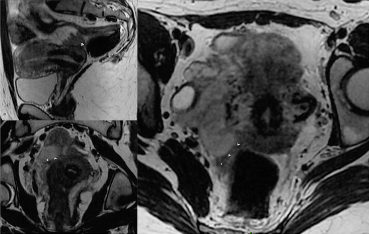 L endom triose Subtile Des Ligaments Ut rosacr s Tech Imago