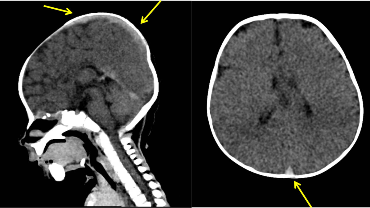 Scanner post mortem en coupe sagittale centrée sur l’encéphale. Dédifférenciation substance blanche-substance grise, sinus veineux spontanément denses (flèches) ; enfant de 2 mois et demi. © Mathilde Ducloyer et al