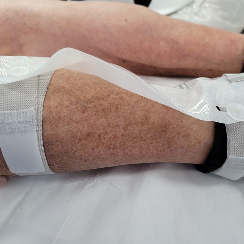 Un pansement type portefeuille sera fait sur le robinet pour éviter les blessures cutanées dues au robinet ou à l’extrémité de la sonde. Les poches à urines seront fixées au niveau des mollets avec des petites bandes velcro adaptées.