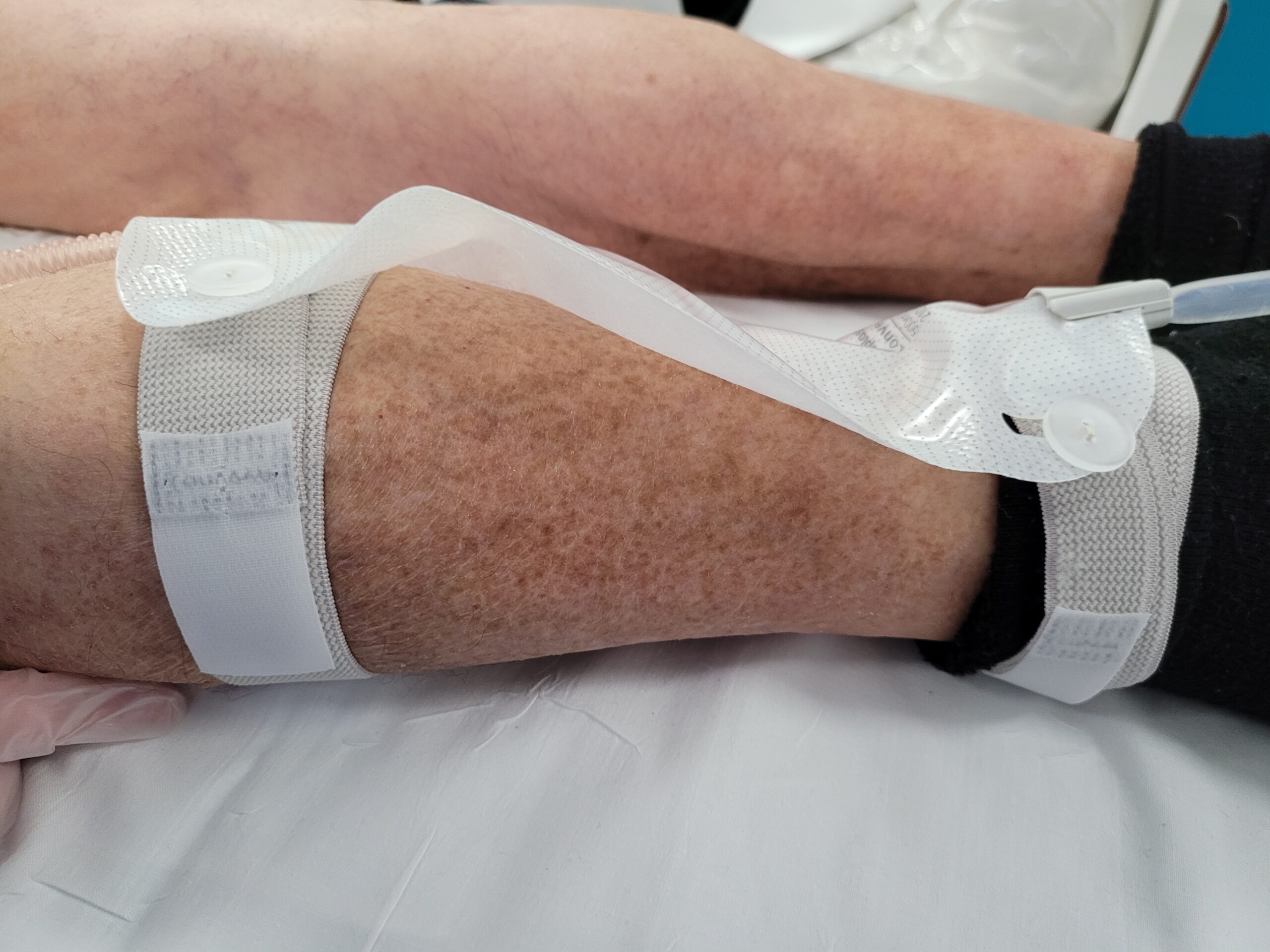 Un pansement type portefeuille sera fait sur le robinet pour éviter les blessures cutanées dues au robinet ou à l’extrémité de la sonde. Les poches à urines seront fixées au niveau des mollets avec des petites bandes velcro adaptées.