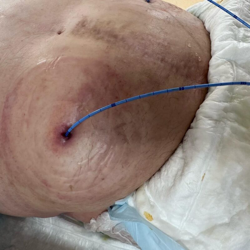 après nettoyage et séchage, un nouveau socle et une nouvelle poche de stomie seront mis en place ainsi que des demi-lunes pour optimiser l’étanchéité du socle. Parfois, cette sonde est également fixée à la poche de stomie par un fil.