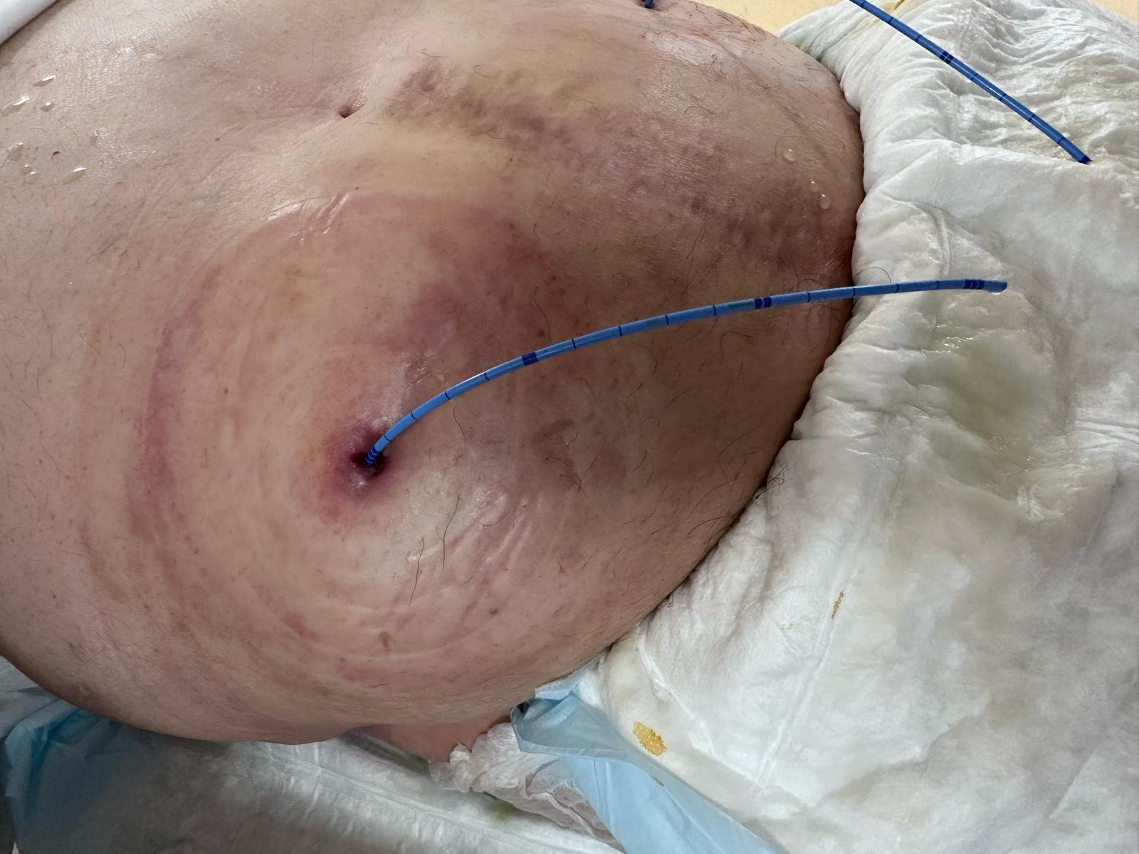 après nettoyage et séchage, un nouveau socle et une nouvelle poche de stomie seront mis en place ainsi que des demi-lunes pour optimiser l’étanchéité du socle. Parfois, cette sonde est également fixée à la poche de stomie par un fil.