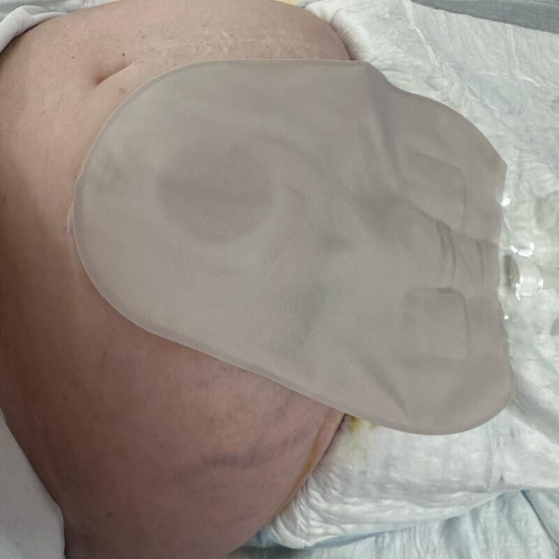 après nettoyage et séchage, un nouveau socle et une nouvelle poche de stomie seront mis en place ainsi que des demi-lunes pour optimiser l’étanchéité du socle. Parfois, cette sonde est également fixée à la poche de stomie par un fil.