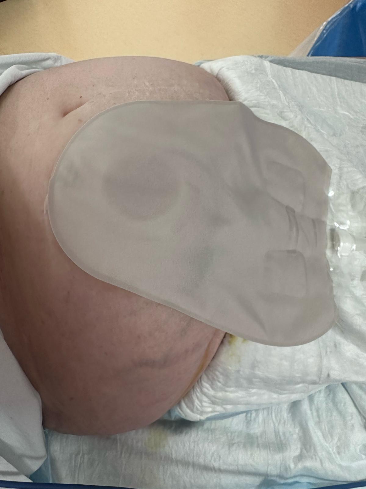 après nettoyage et séchage, un nouveau socle et une nouvelle poche de stomie seront mis en place ainsi que des demi-lunes pour optimiser l’étanchéité du socle. Parfois, cette sonde est également fixée à la poche de stomie par un fil.