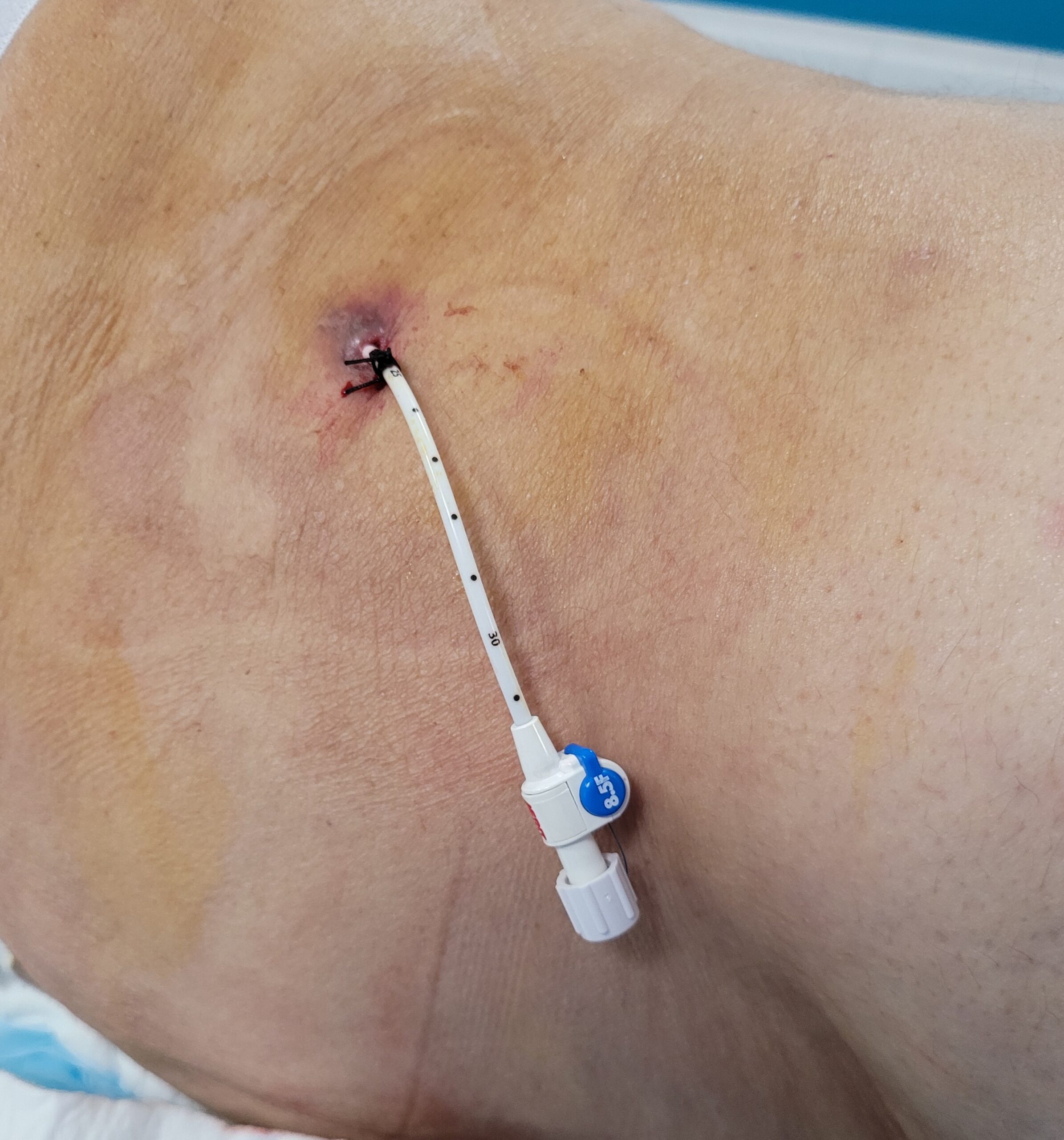 La sonde est fixée à la peau à l’aide d’un fil de suture non résorbable type soie.