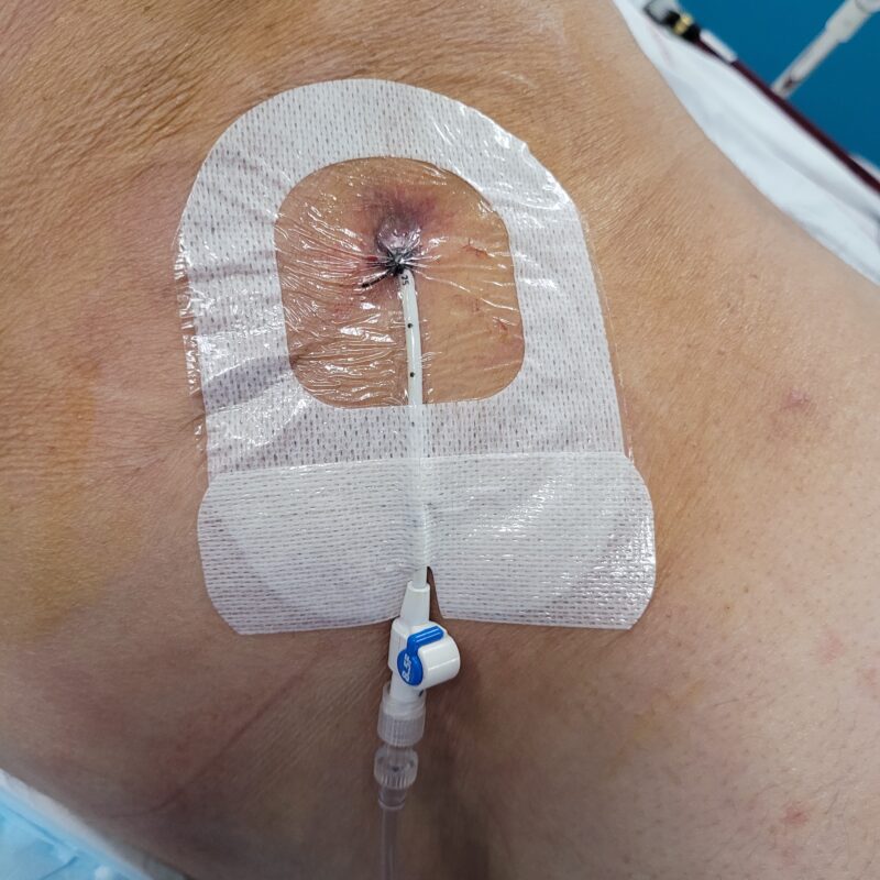 Un pansement type portefeuille sera fait sur le robinet pour éviter les blessures cutanées dues au robinet ou à l’extrémité de la sonde. Les poches à urines seront fixées au niveau des mollets avec des petites bandes velcro adaptées.