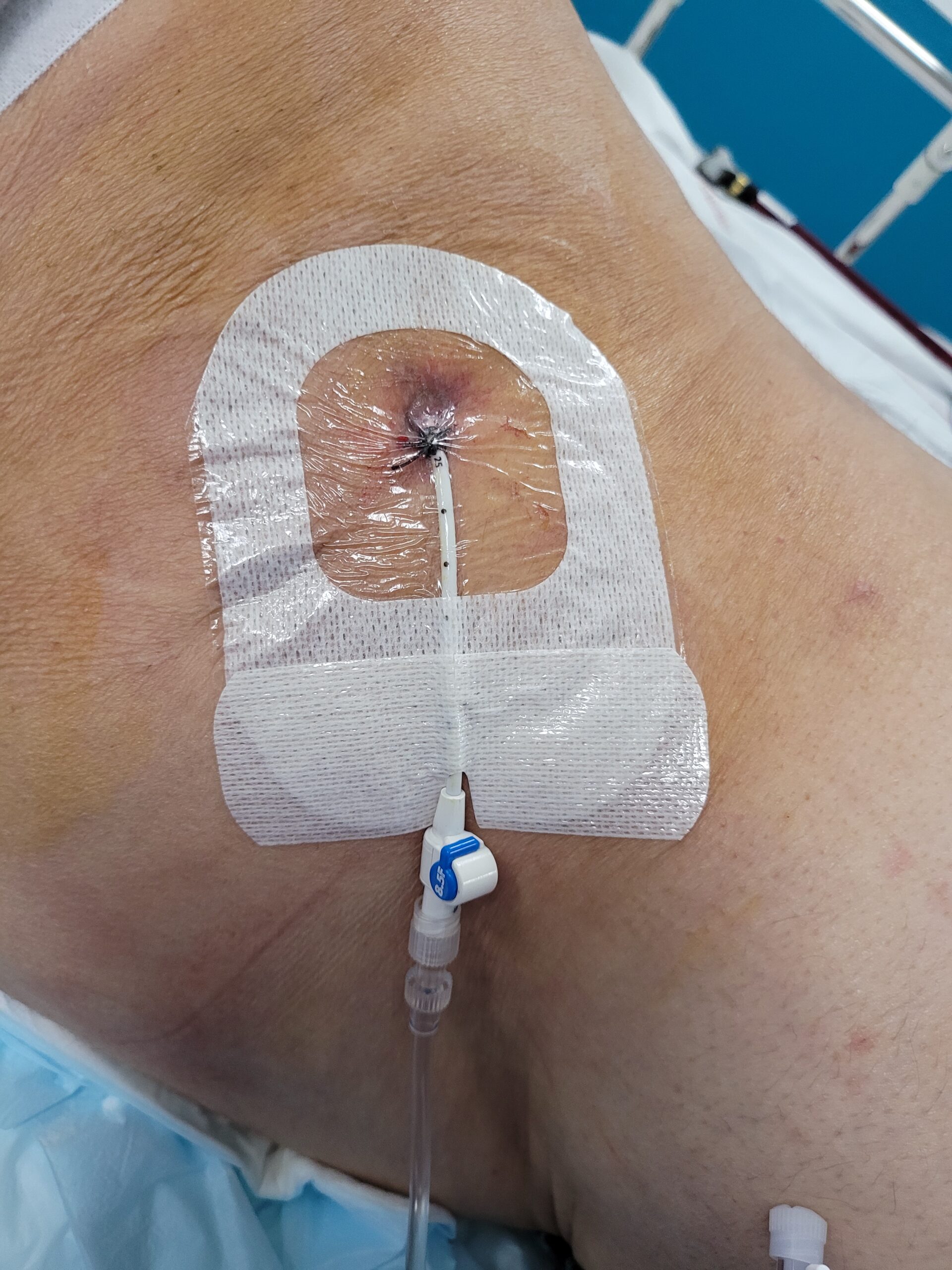 Un pansement type portefeuille sera fait sur le robinet pour éviter les blessures cutanées dues au robinet ou à l’extrémité de la sonde. Les poches à urines seront fixées au niveau des mollets avec des petites bandes velcro adaptées.