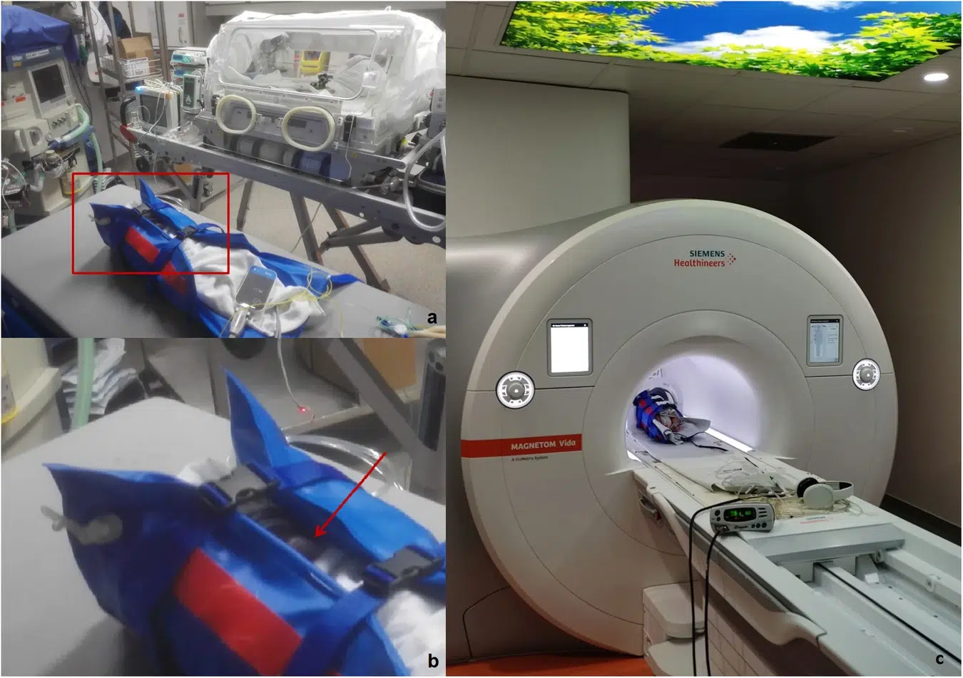 immobilisation of a premature patient in the MR preparation room. The child is transferred from the incubator into the vacuum mattress, MR-compatible monitoring is applied (a) and a pacifier (b, red arrow) is used. After vacuum has been applied, the child is taken into the MR scanner (c).