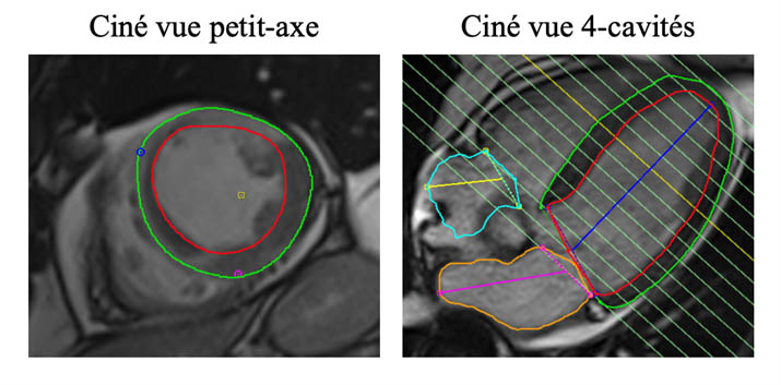 Figure 1. Le contourage automatique de l’endocarde (rouge) et l’épicarde (vert) en télésystole et télédiastole permet une mesure précise de la fraction d’éjection du ventricule gauche sur une imagerie ciné. La mesure en petit axe est plus précise et plus reproductible que les mesures biplanaires en IRM ou en échographie : chez ce patient, la FEVG est mesuré à 34 % en IRM contre 40 % en échographie, ce qui change la prise en charge.